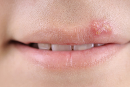 Treat herpes with Valtrex