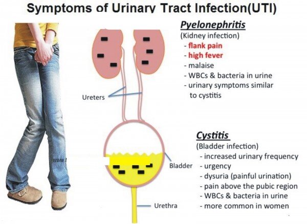 Symptoms of a urinary tract infection
